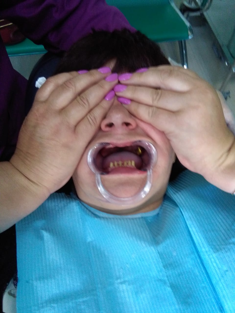Описание пломбированиия зубов в Китае